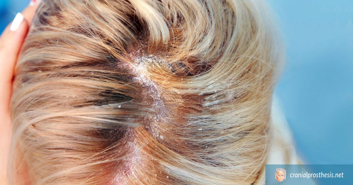 Close-up of irritated scalp